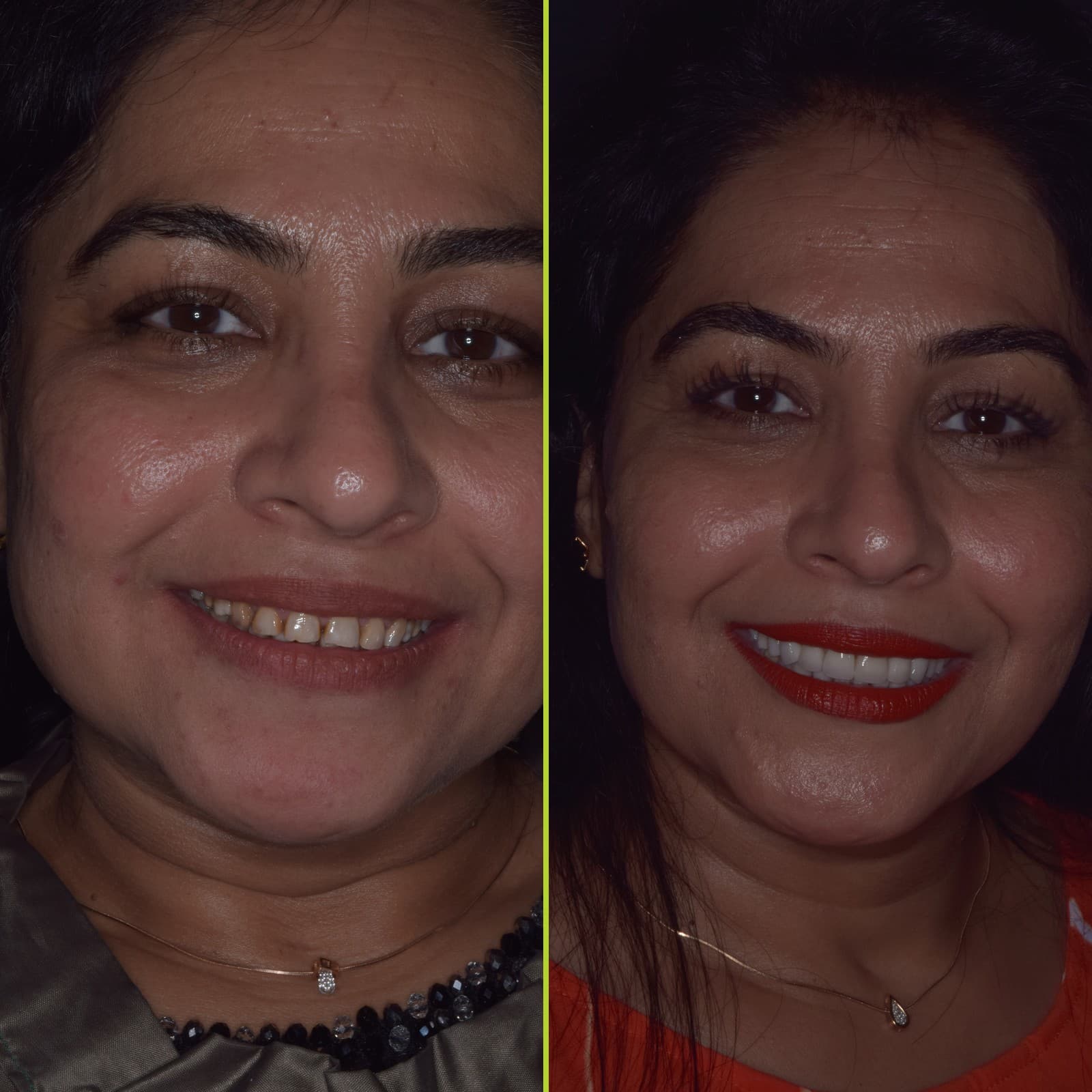 Before and after smile designing results