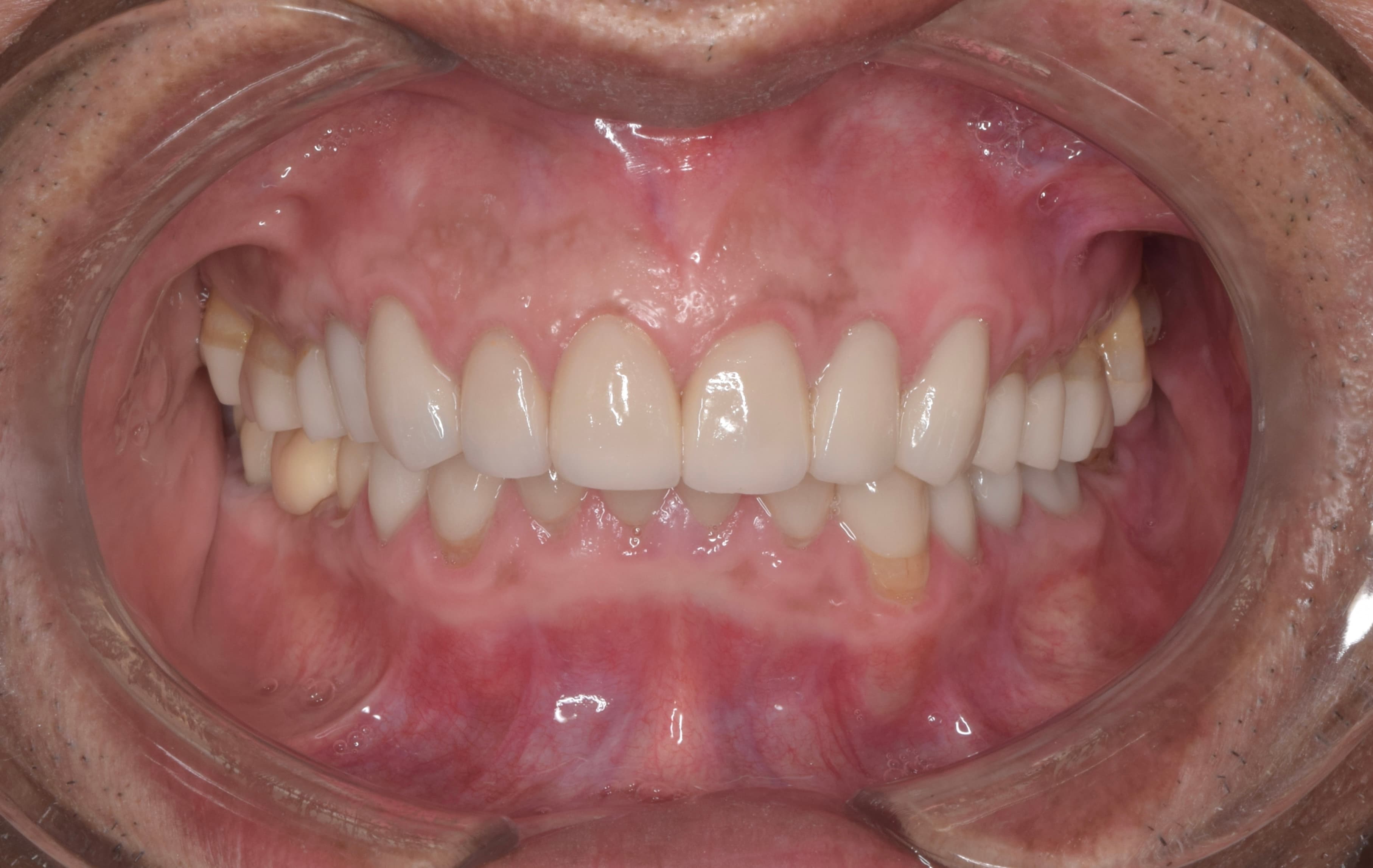 After — Generalised wear and collapsed bite