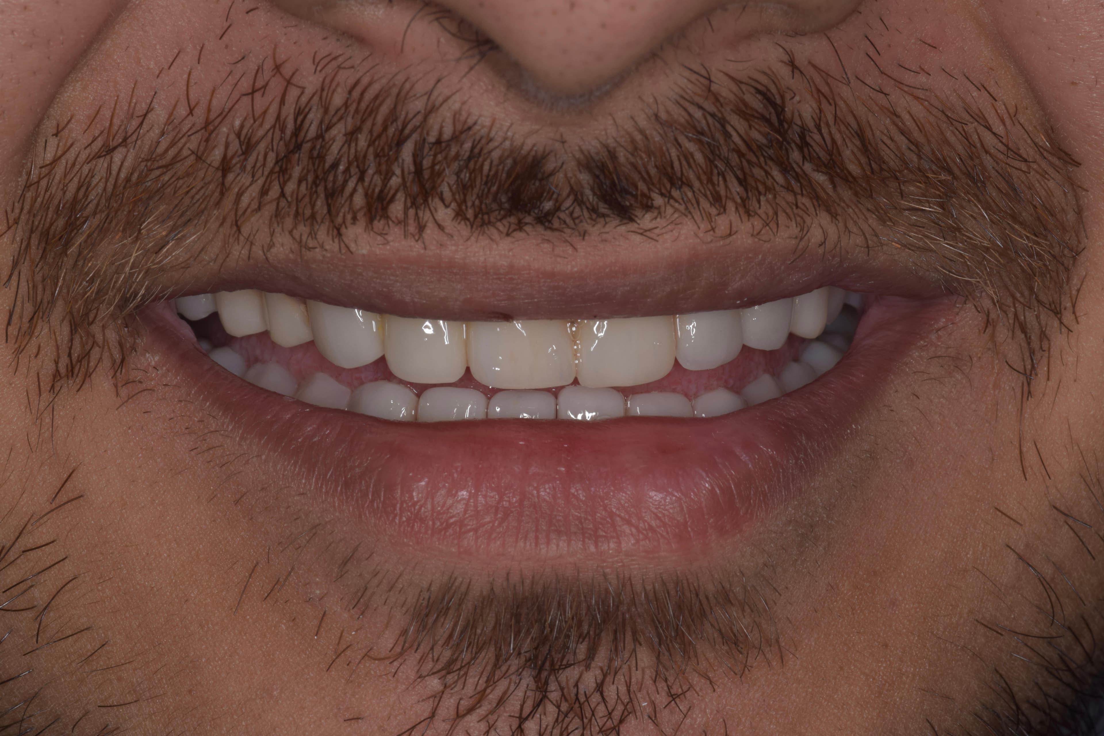 After — Closing spaces in the upper front teeth