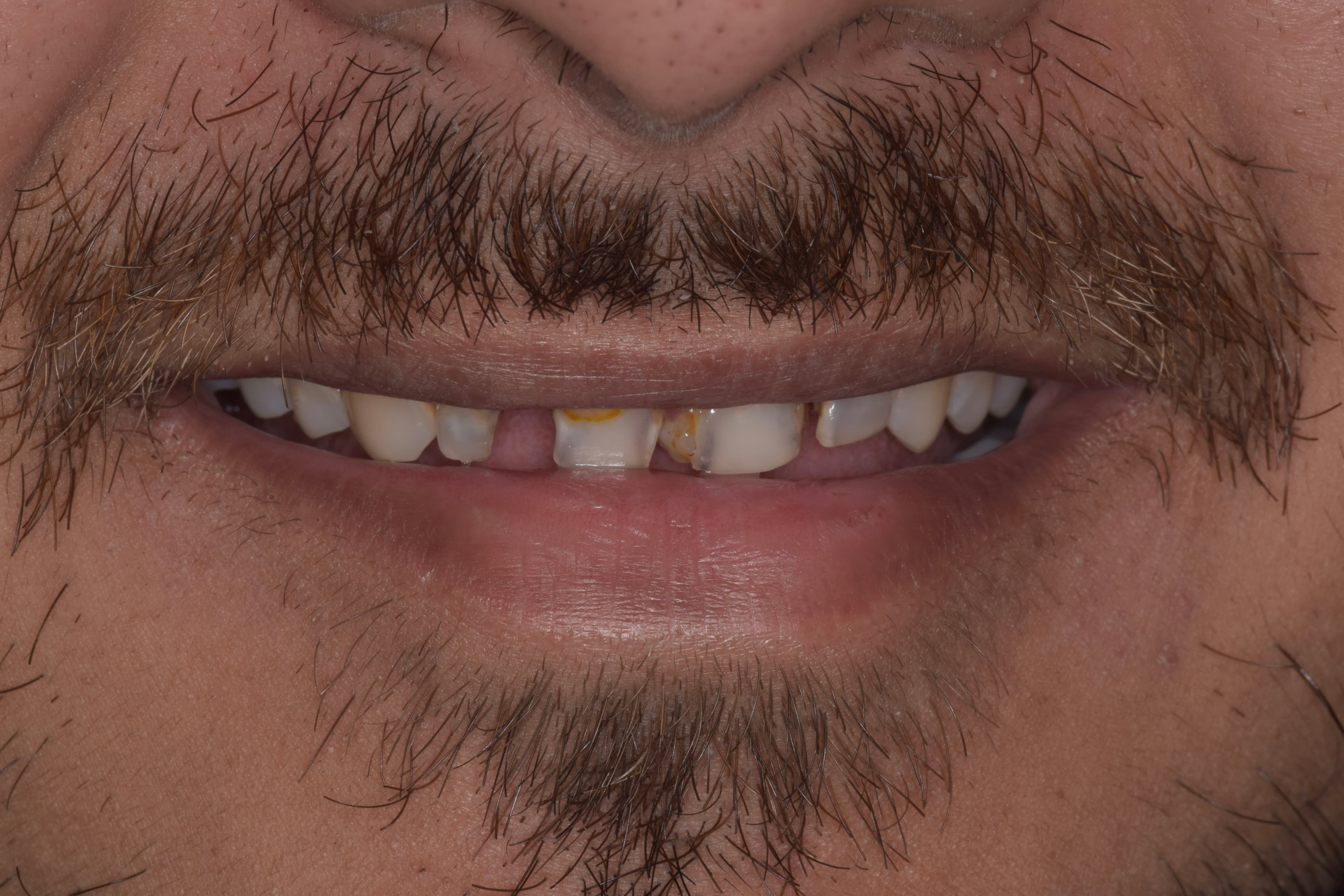 Before — Closing spaces in the upper front teeth