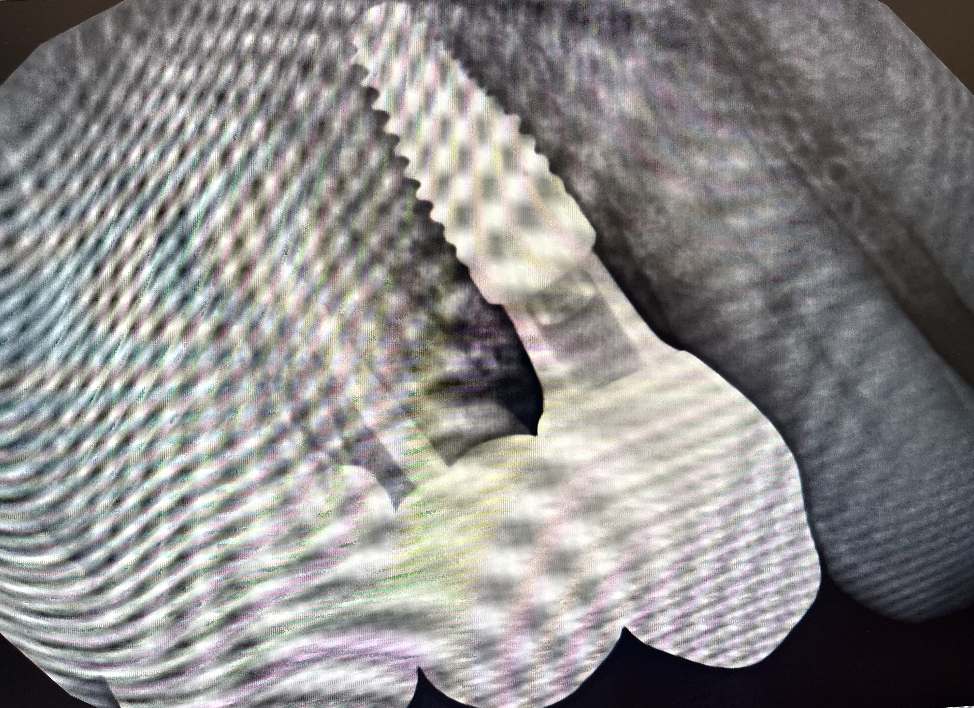 Are Dental Implants Painful? What to Actually Expect