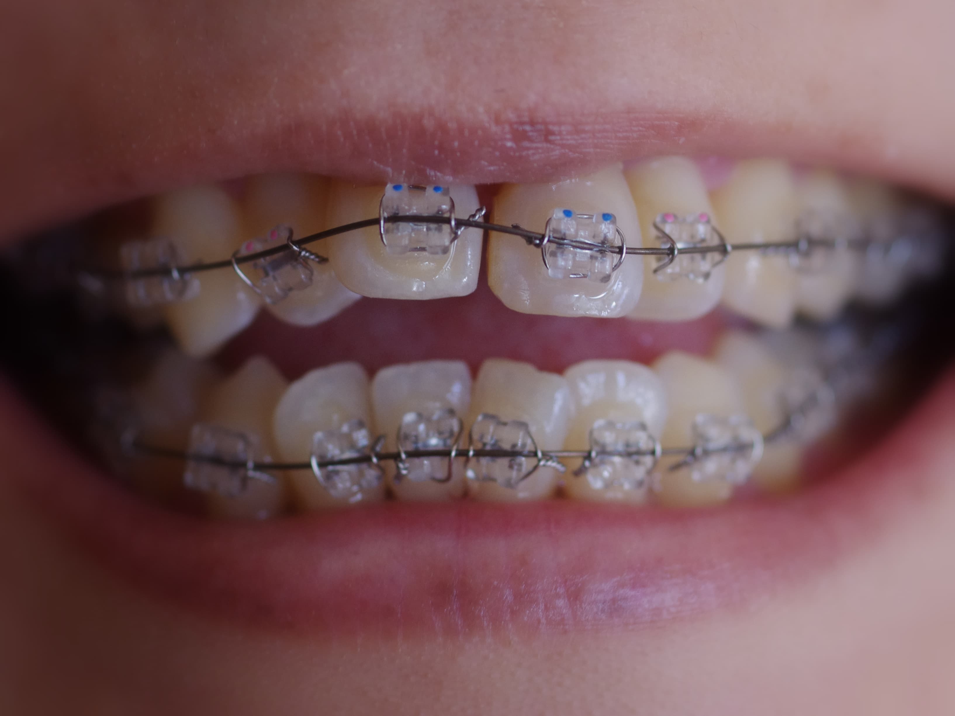 Clear Aligners vs. Traditional Braces: A Straightforward Comparison